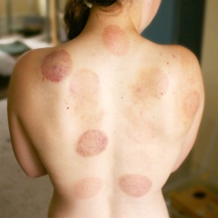 Bruising on back from Cupping.jpg